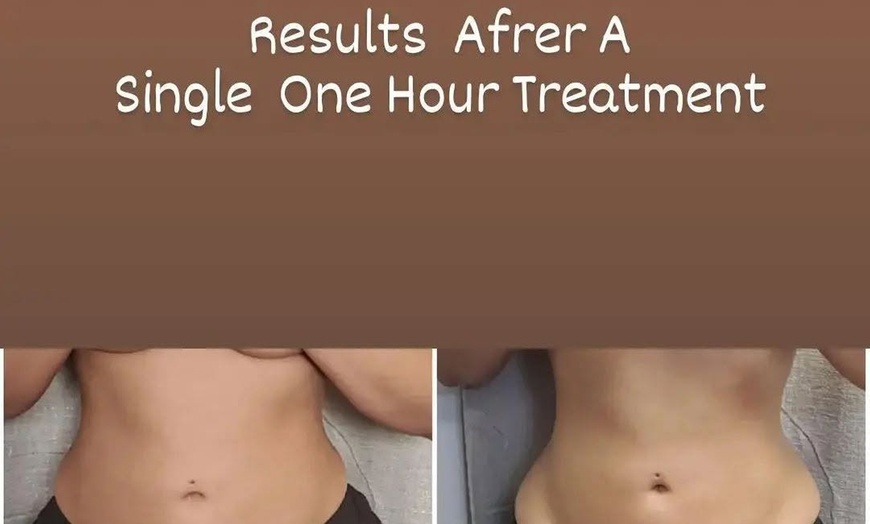 Image 4: Sculpt & Smooth: Body Contouring with Wood Therapy, Cavitation & RF
