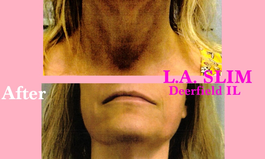 Image 5: Non-Invasive Face Lifts Using Radio Frequency Therma Lift