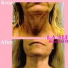 Image 5: Non-Invasive Face Lifts Using Radio Frequency Therma Lift