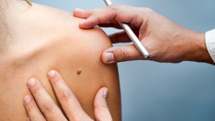 (EARLY BIRD-LIMITED) Skin Tag Removal for Up to 5 Skin Tags for 2mm Size - MPI Clinic