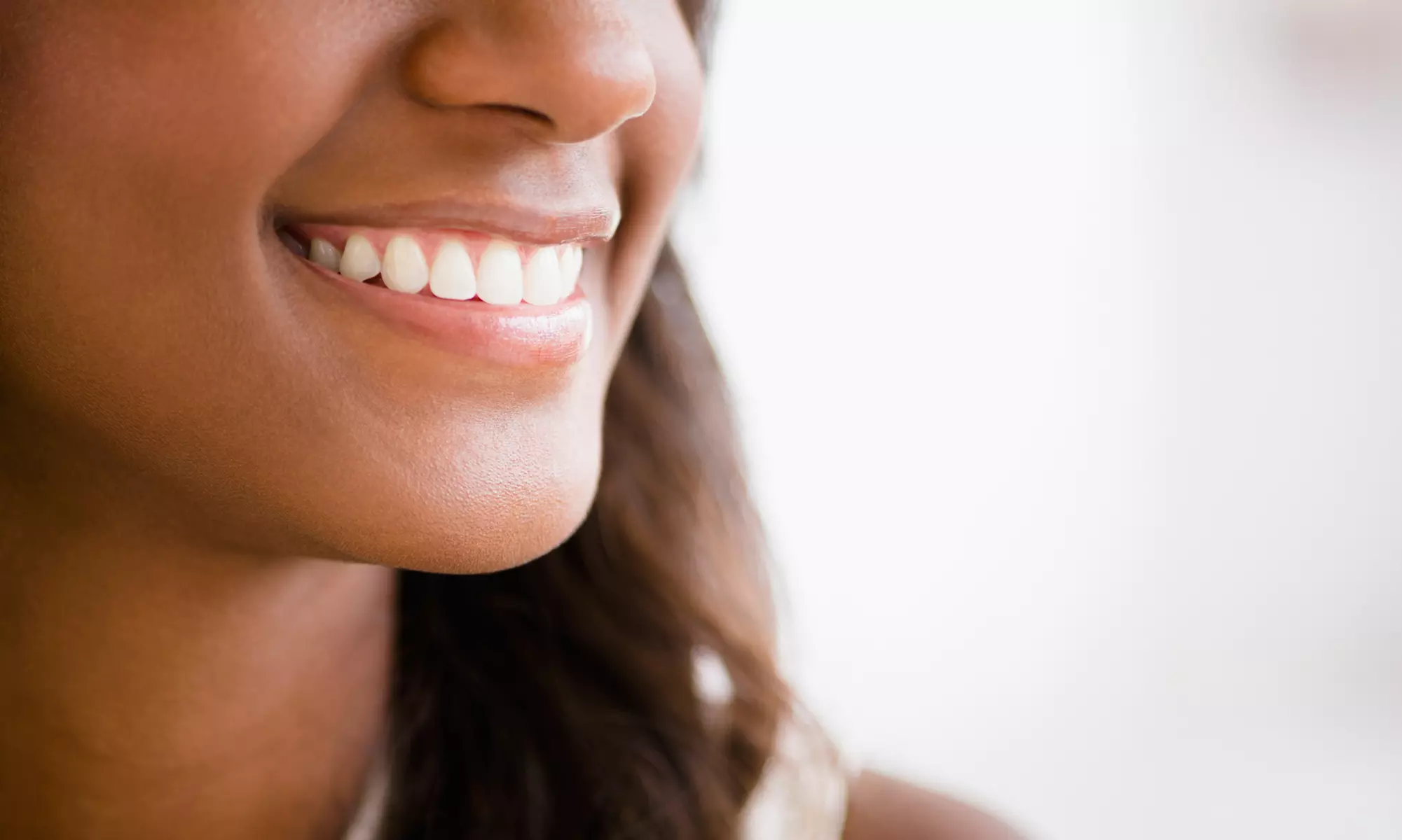 Up to 26% Off on Teeth Whitening - In-Office - Non-Branded at Sparkling White Smiles - Charlotte - Primary Image