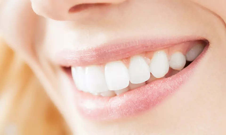 Two, Four, or Six Porcelain Veneers with Exams and X-Rays at Smile Up Dentistry (Up to 62% Off) - Primary Image