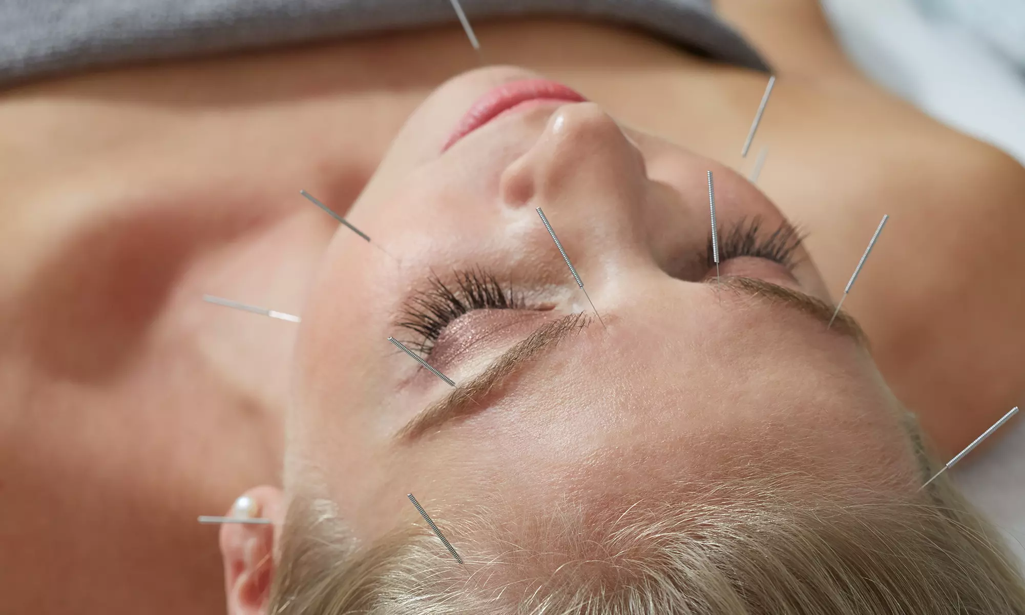 One or Two Facial Acupuncture Sessions at Chung Ying Physical Therapy & Acupuncture (Up to 55% Off) - Primary Image