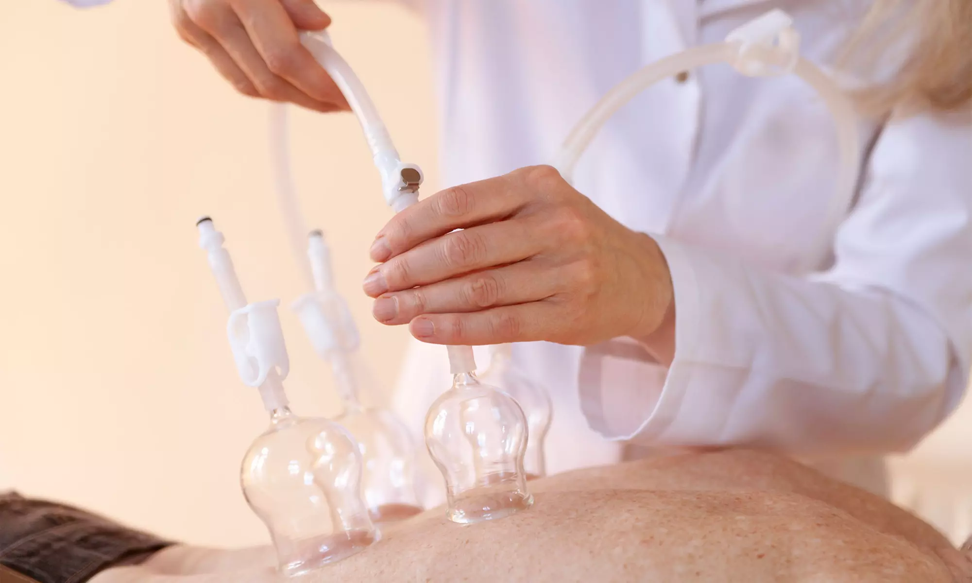 Up to 83% Off on Cupping at New Joy Acupuncture - Primary Image