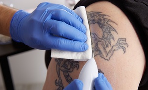 Laser Tattoo Removal