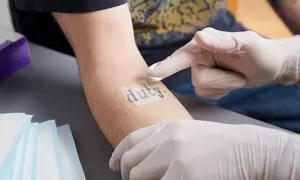 3, 6, 9 o 12 sesiones de eliminación de tatuajes con láser Neodimio Yag Q-Switched desde 79,95 € en Baobá