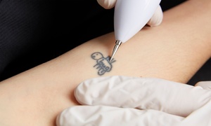 Tattoo Removal  Advanced Laser Aesthetics