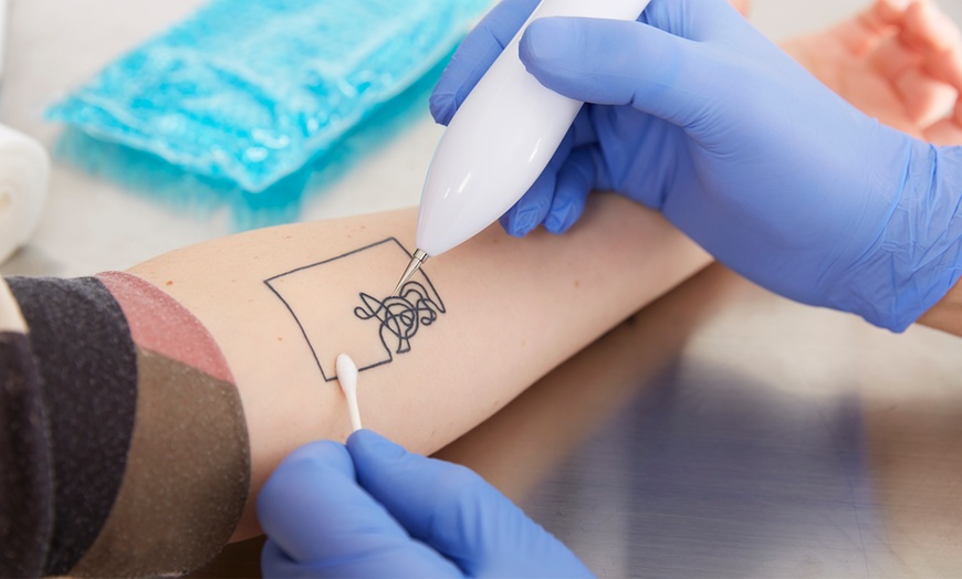 Image 1: 3 o 6 sesiones de eliminación de tatuajes con láser para 1 persona