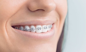 Dental Wizard: Stały aparat ortodontyczny: 1 łuk aparatu stalowego za 529 zł i więcej opcji w Dental Wizard w Gdańsku