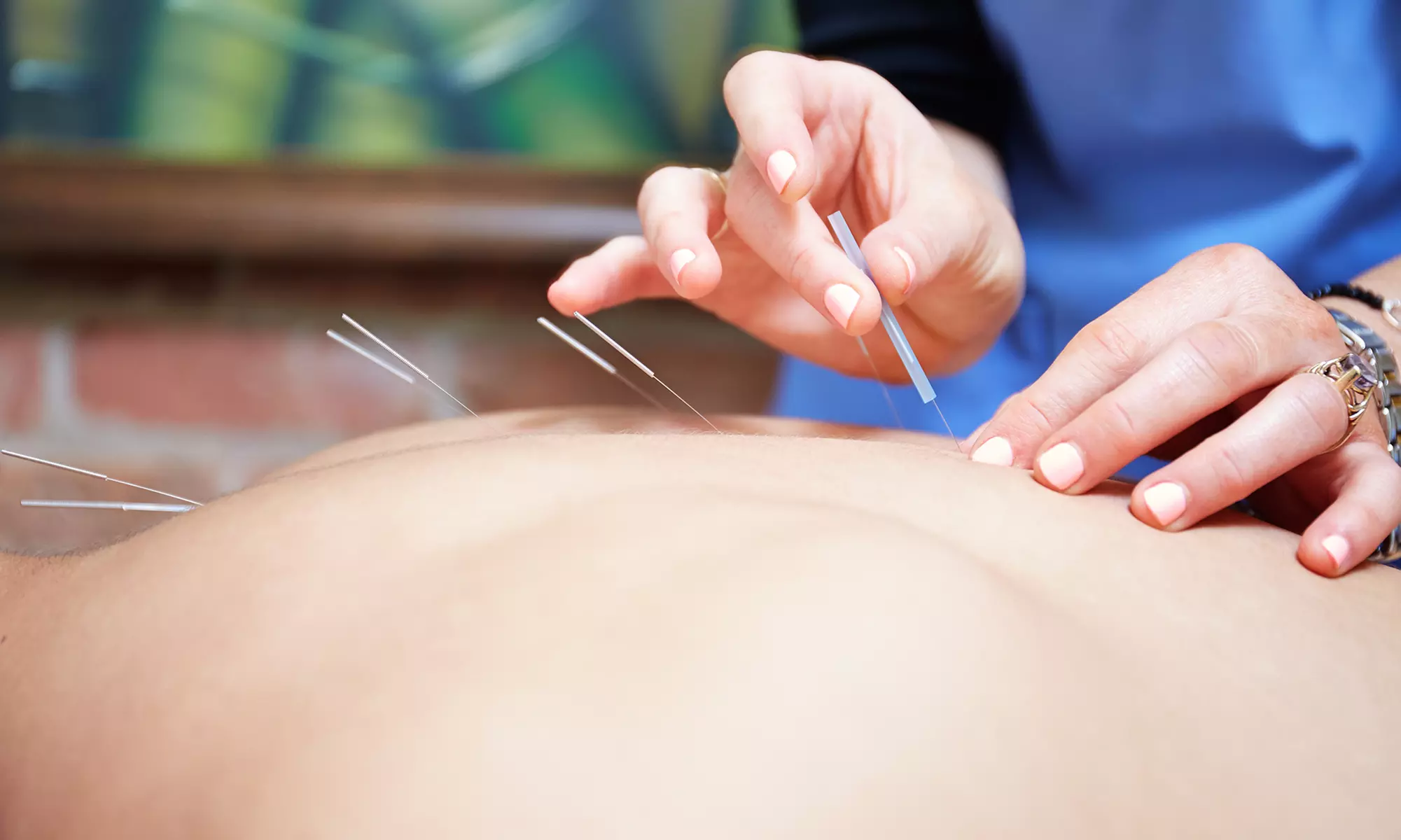 One 60-Minute Acupuncture Session w/ Cupping Treatment at Shin Acupuncture and Wellness Center (Up to 55% Off)
 - Primary Image