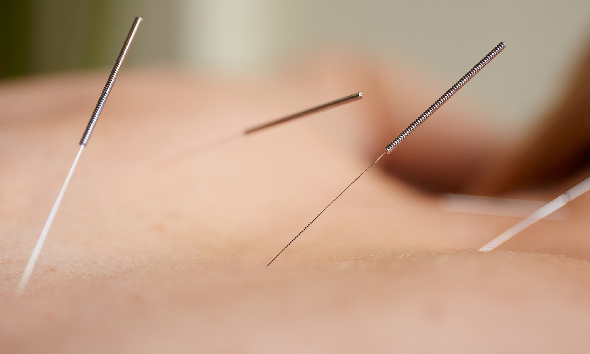 Experience holistic acupuncture sessions with tui-na massage