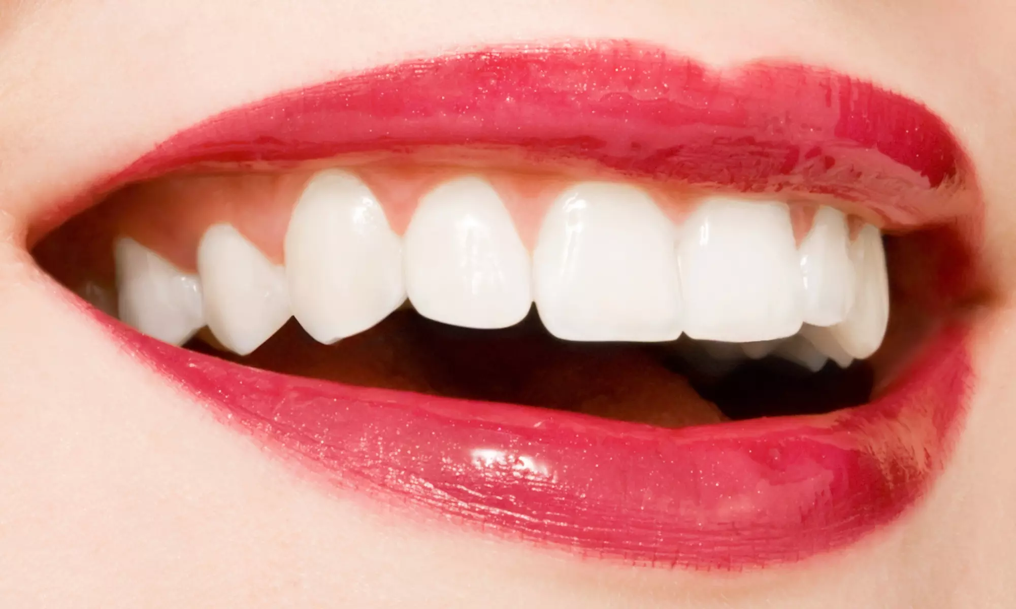 Enhance Your Smile with Exam, X-rays & Cleaning or Veneers Crowns at Bright Dental Solutions (Up to 79% Off) - Primary Image