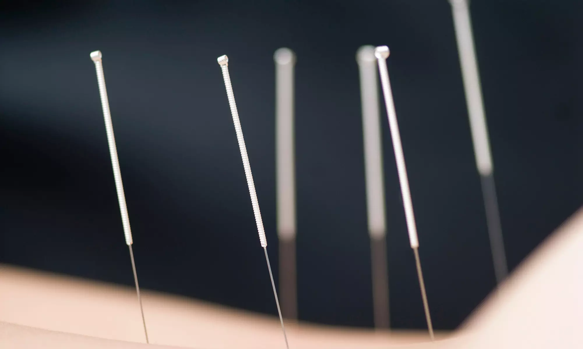 One, Three, or Six Sessions of Acupuncture for Sinus or Pain Care at Time Acupuncture Clinic (Up to 50% Off) - Primary Image