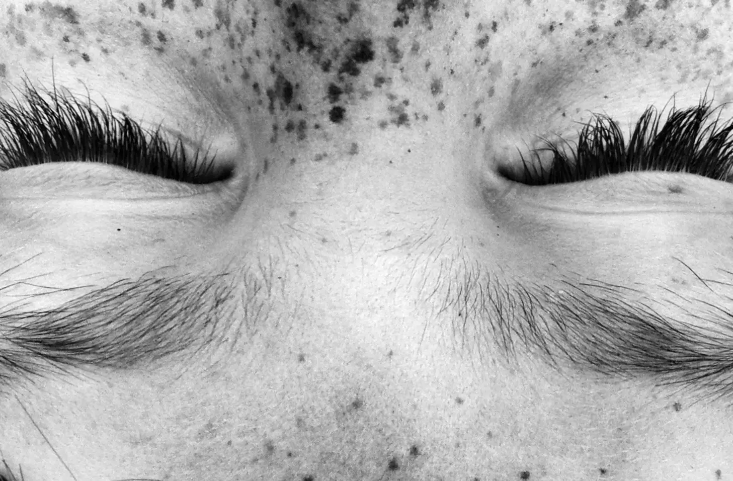 Skin Tightening and Wrinkle Reduction for Face and Neck (Radio Frequency Treatment) - Primary Image