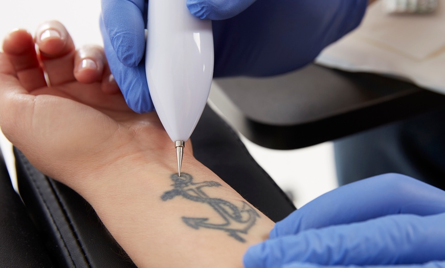 Laser Tattoo Removal in Brentwood TN and Nashville