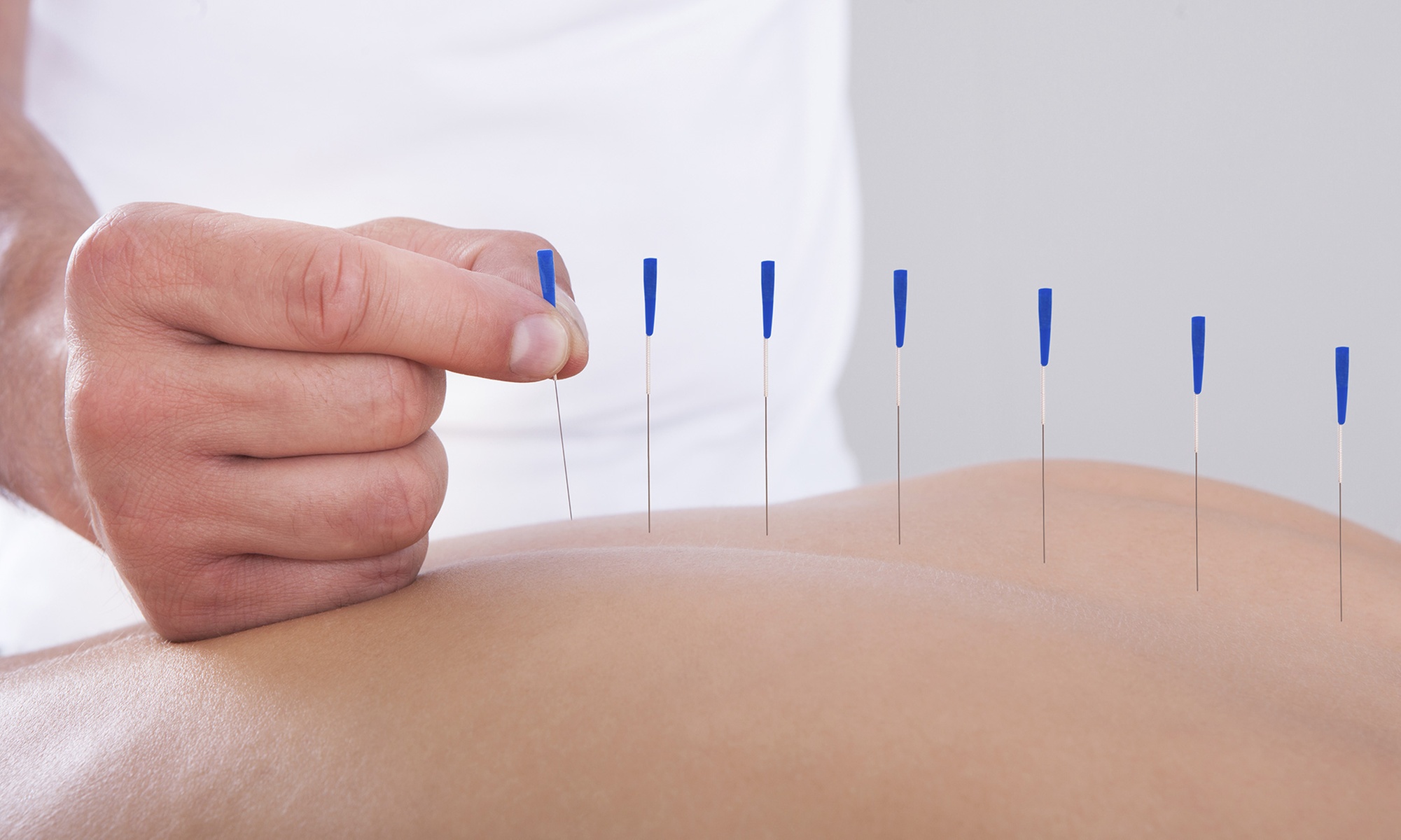 Experience Cupping/Guasa and Acupuncture Bliss for Targeted Relief