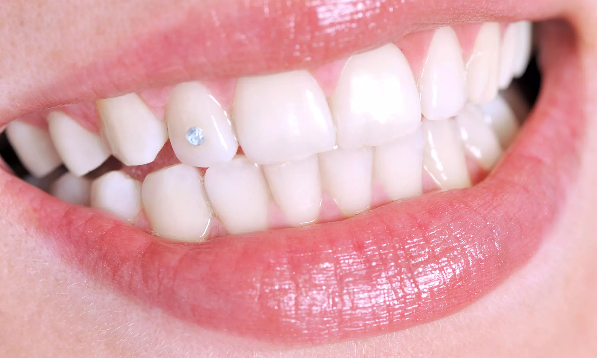 Przyklejanie biżuterii nazębnej w Dental Bar & Studio wybielania zębów (do -20%) - Primary Image