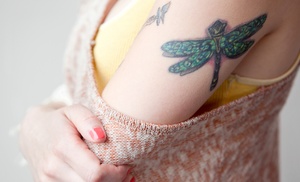 Láser para eliminar tatuajes Láser para eliminar tatuajes