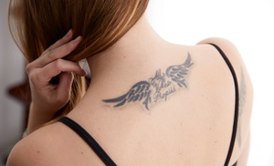 Eliminación de tatuaje con láser en IBWellness Boutique & Fitness