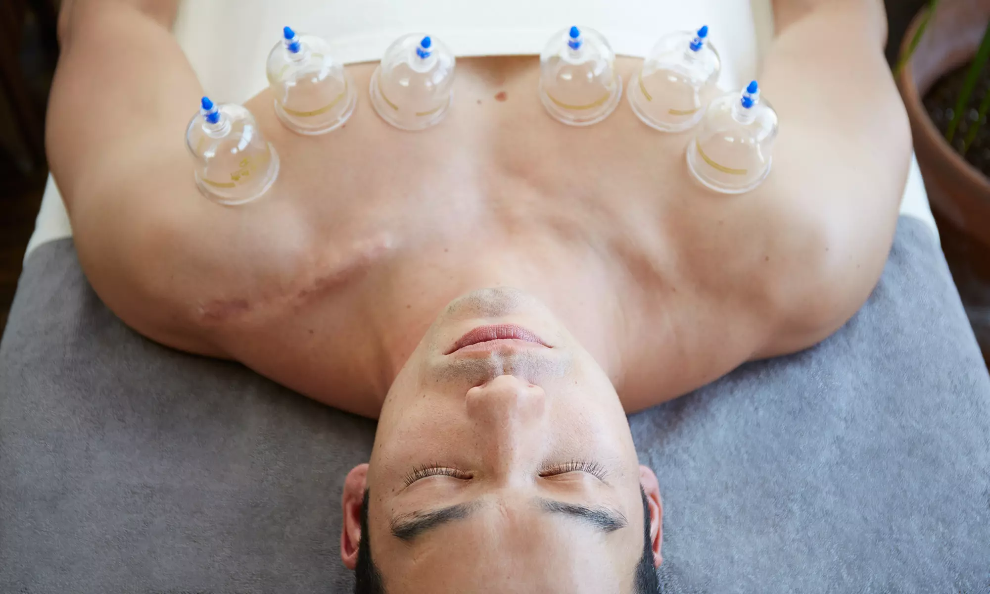 Consultation with 1 or 3 Cupping and Acupuncture Sessions at New Life Chiropractic and Wellness (Up to 89% Off) - Primary Image