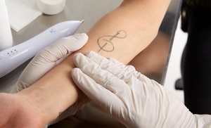 Up to 71% Off on Tattoo Removal at London Laser tattoo removal