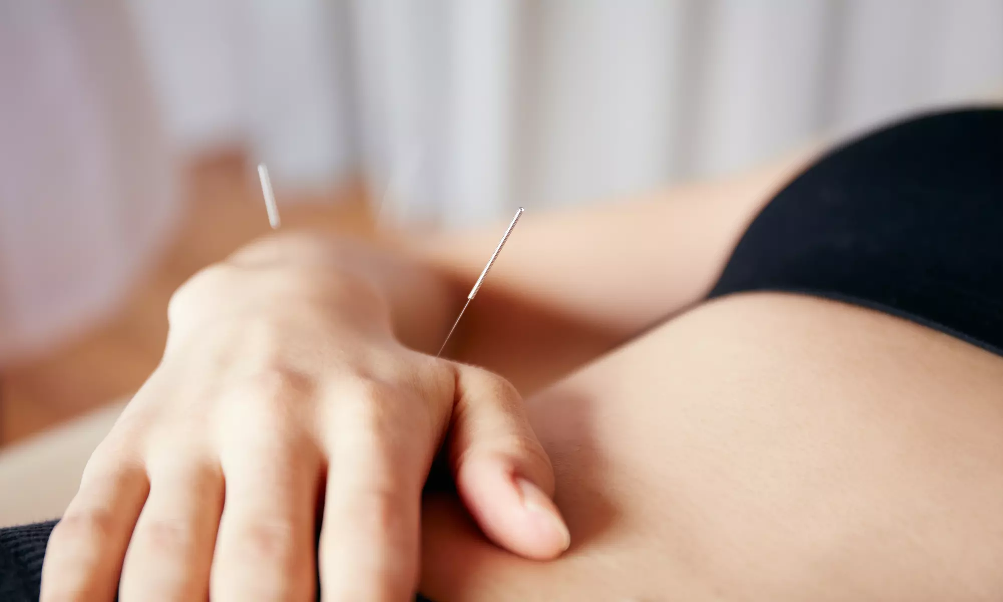 One or Two 30-Minute Acupuncture Treatments at Integrative Wellness Center of Jacksonville (Up to 51% Off) - Primary Image