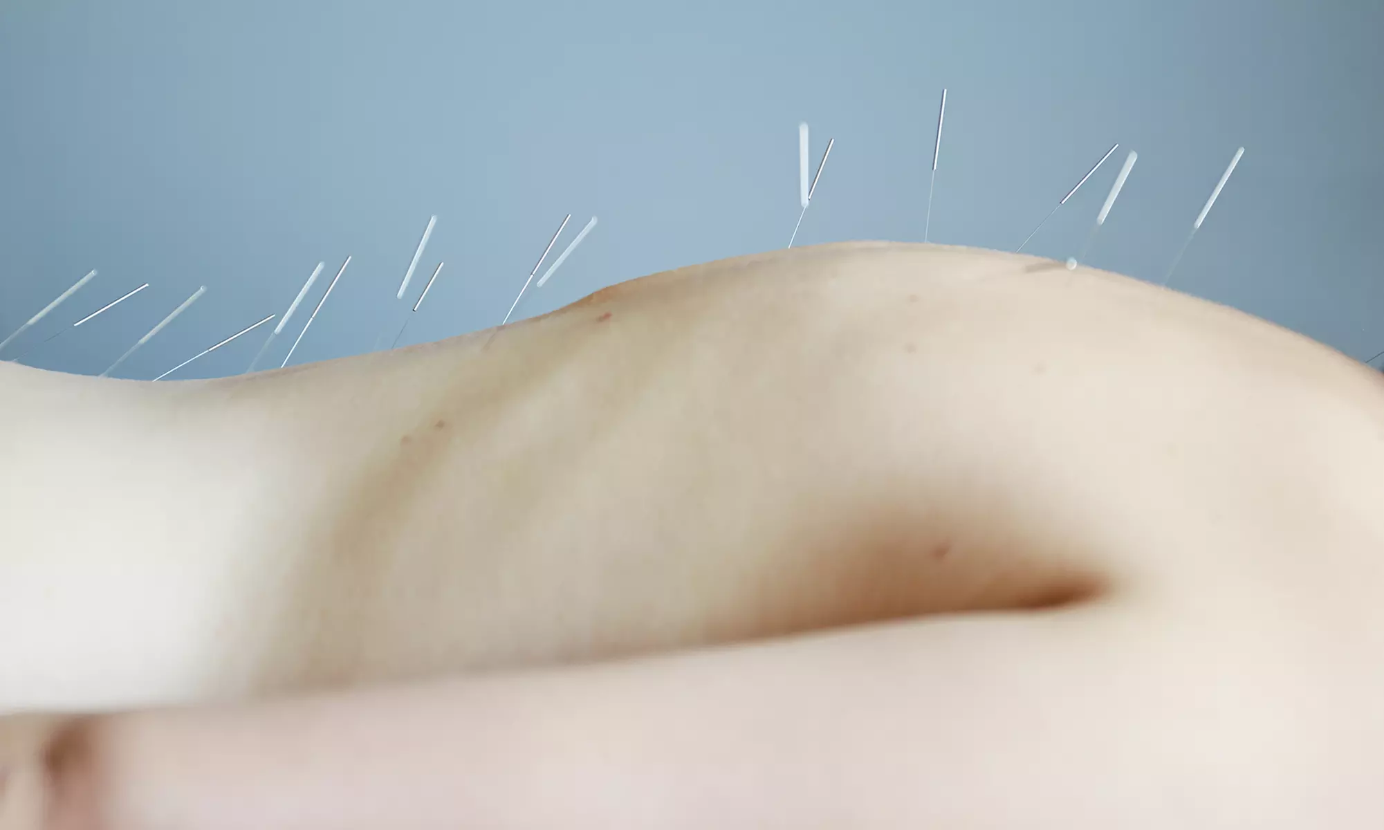 Acupuncture/Cupping at Calgary College