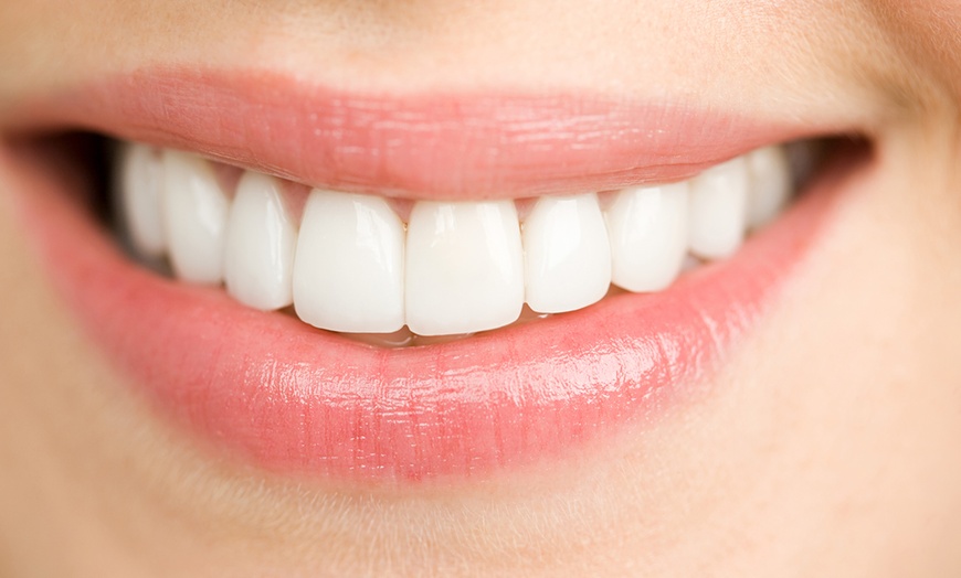 One Dental Composite Veneer - Warwick Road Dental | Groupon