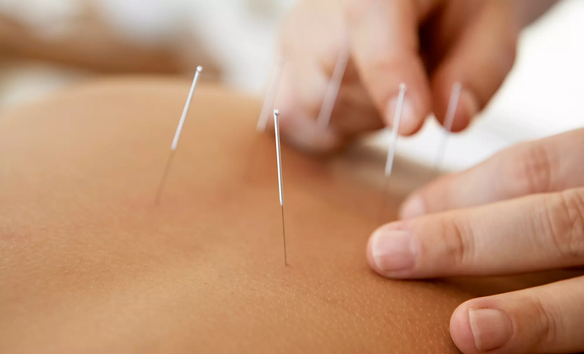 Experience holistic healing with Lawrence Miller's acupuncture and cupping sessions, offering up to 82% off on comprehensive care. - Primary Image
