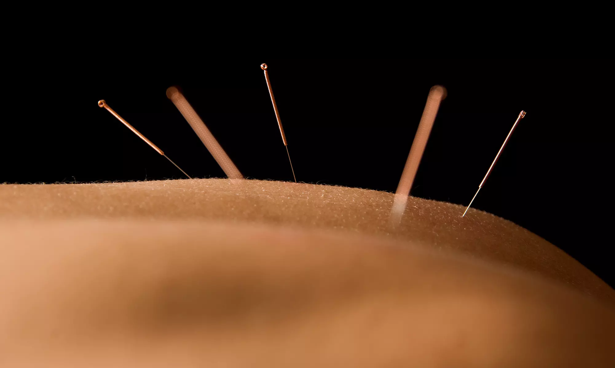 Exam and One or Three Acupuncture Sessions from North Shore Wellness Centre (Up to 72% Off) - Primary Image