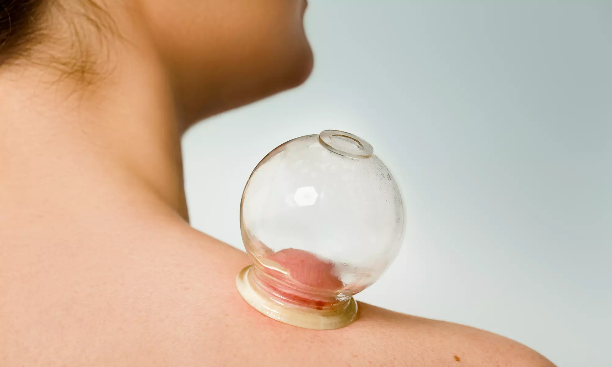 One or Three Cupping Sessions at Integrated Physical Medicine (Up to 52% Off) - Primary Image