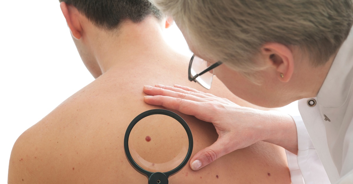 Mole, Wart or Skin Tag Removal 