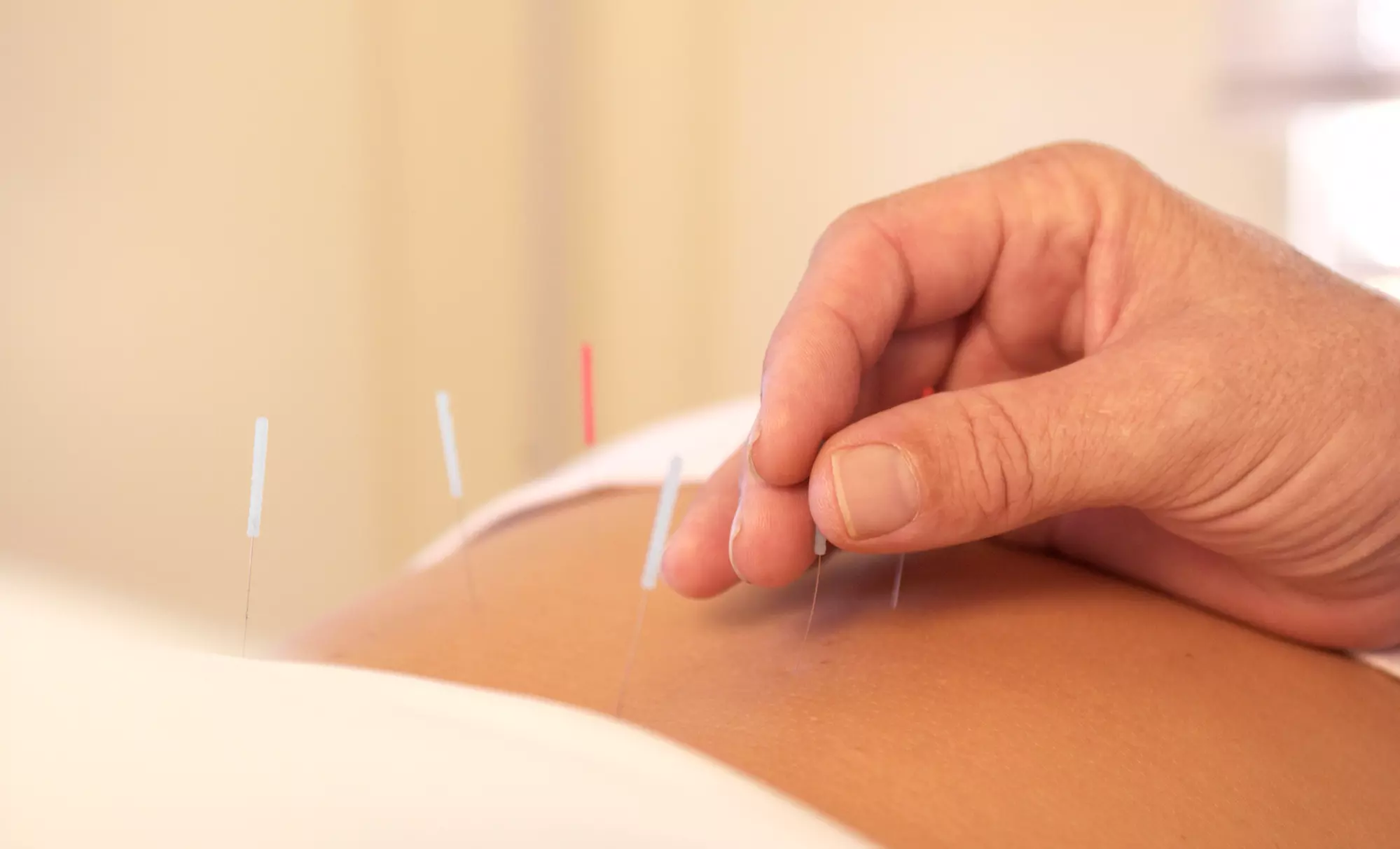 Acupuncture and Cupping Sessions at Good Morning Acupuncture (Up to 50% Off). Three Options Available. - Primary Image