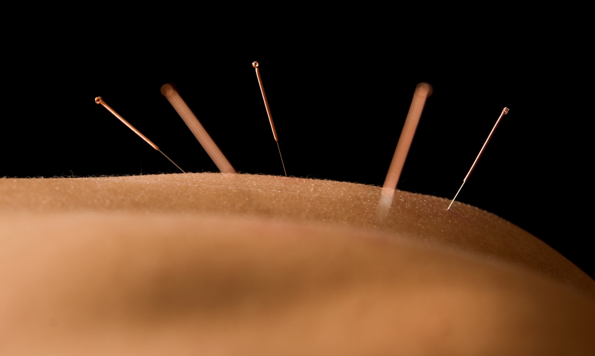 Experience the Benefits of Acupuncture with One or Two Sessions