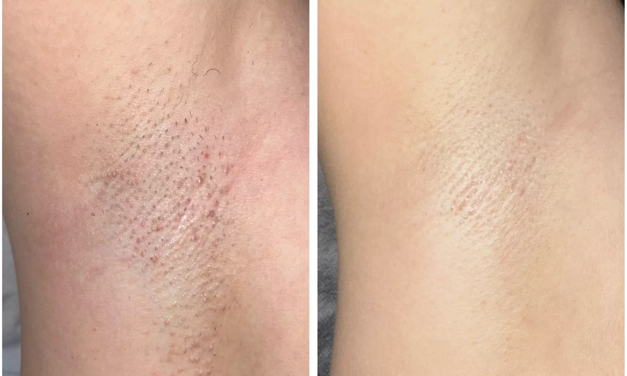 Do 50% zniżki na Depilacja laserowa w Kosmetologia estetyczna - depilacja laserowa