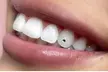 Shine Bright at ALICE BEAUTY SALON RI by Adding One Tooth Gems or a Tooth Gems Butterfly (Up to 36% Off) - Second Medium