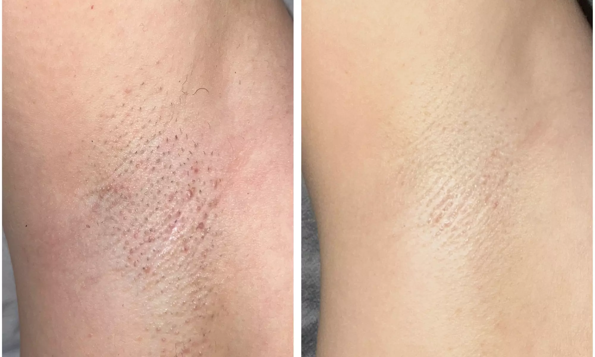 Do 50% zniżki na Depilacja laserowa w Kosmetologia estetyczna - depilacja laserowa