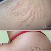 Image 1: Traitement des vergetures STRIORT d'une heure