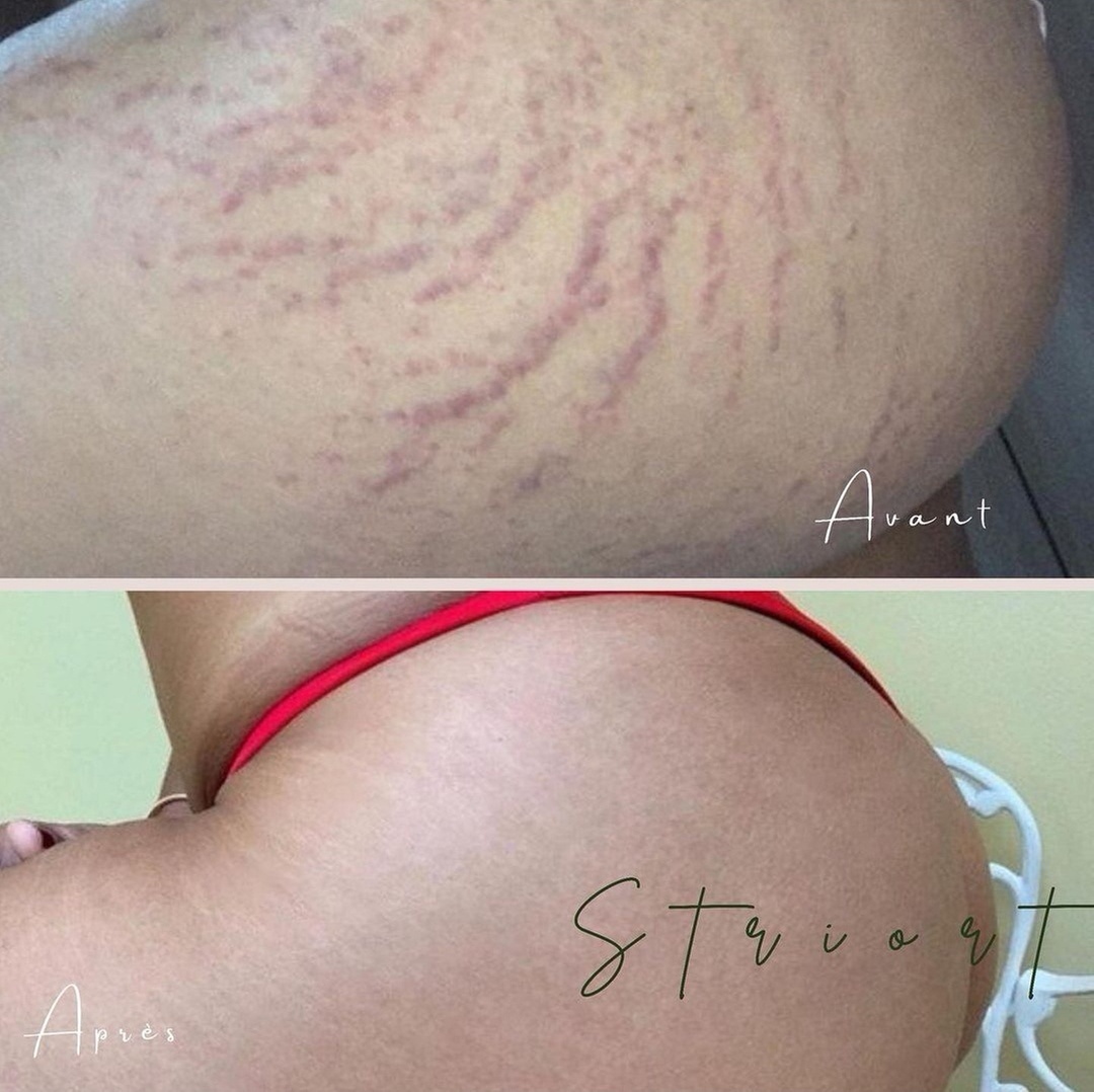 Traitement des vergetures STRIORT d'une heure