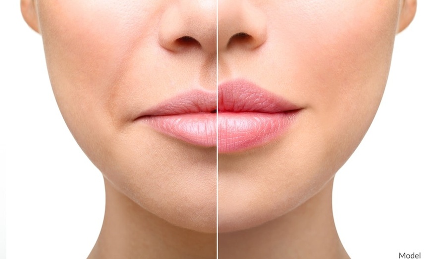 Image 1: Forehead Line Softening & 1ml Lip Enhancement for a Radiant Look