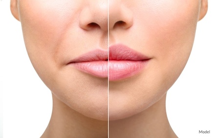 1ml Dreamy Non-Surgical Lip Augmentation - Lueur Group Pty Ltd