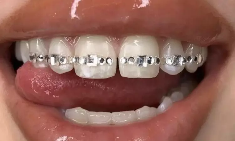 Up to 50% Off on Denture Services at Pdx Gems - Primary Image