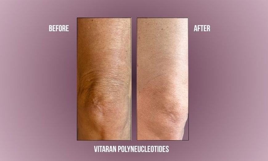 Image 5: Polynucleotides Regenerative Treatment at Divine Aesthetics in London