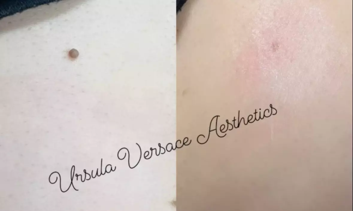 Experience Ursula Versace Aesthetics' beauty package with up to 30% off for 1 to 4 skin tags removal - Second Medium