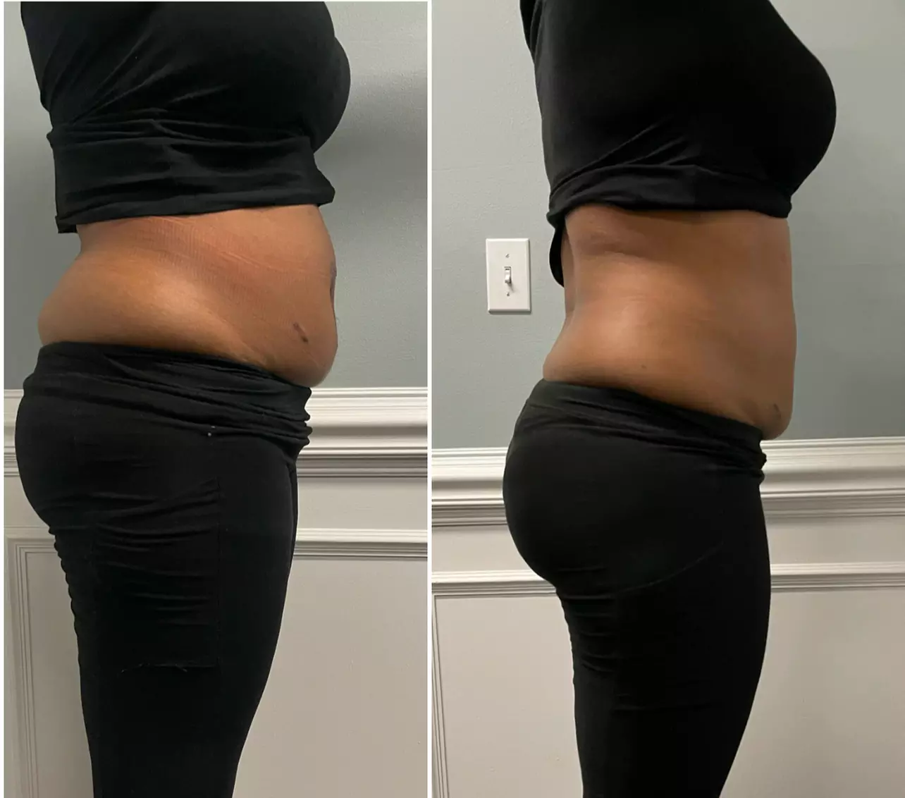 Up to 50% Off on Cavitation at Vividvesthetics skin&body