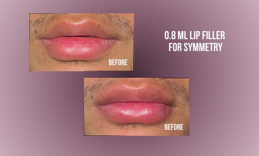 Image 9: Up to 38% Off on Injection - Dermal Filler at Divine Aesthetics Clinic London