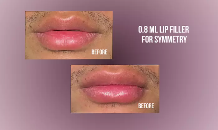 Up to 38% Off on Injection - Dermal Filler at Divine Aesthetics Clinic London