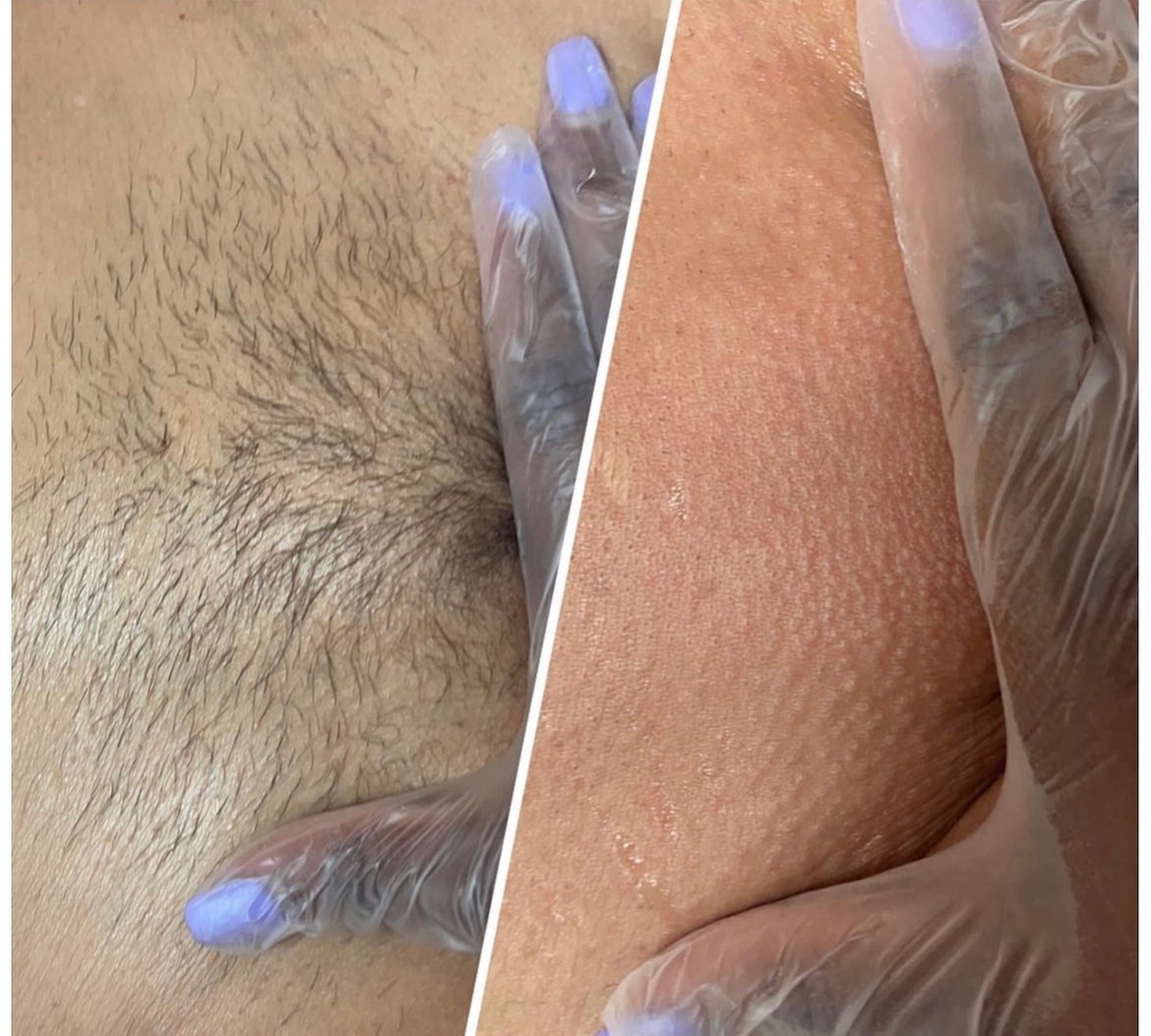 Get Smooth Skin with Brazilian with Optional Underarms or Vagacial