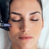 Image 2: Microneedling with Laser Resurfacing for the Hands, Lower Eyes, Neck, or Full Face at Loma Laser (Up to 47% Off)