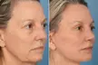 Half / Full Syringe of Lip Filler or LIQUID FACELIFT @ Quality MEDSPA (Up to 67%Off) - Second Medium